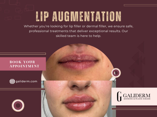 In the evolving landscape of aesthetic enhancements, lip fillers have often garnered significant attention, frequently associated solely with achieving a fuller pout. While lip augmentation is certainly a popular use, this narrow focus overlooks the broader, more transformative potential of dermal fillers in general. 

Official Website: https://galiderm.com 

Address: 9100 Belvedere Rd STE 105, Royal Palm Beach, FL 33411, United States

Phone: +15613360994

Find Us On Google Map: https://maps.app.goo.gl/nPWNimFUMr9oCcss9

Our Profile:

https://photouploads.com/galiderm

Next Links: 

https://tinyurl.com/26pu45av
https://tinyurl.com/2cv3qexp
https://tinyurl.com/2dpz6srq
https://tinyurl.com/29mvyo6z